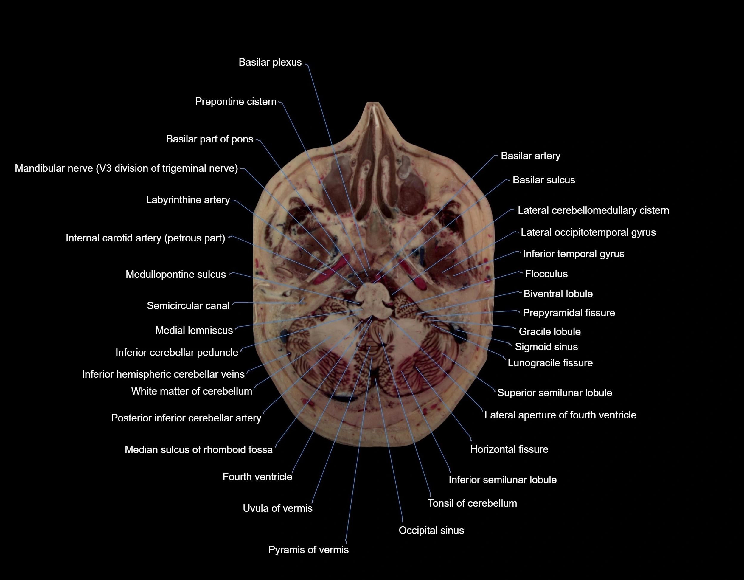 MRI Brain axial cross sectional radiology anatomy 3T image  -img-000015.webp